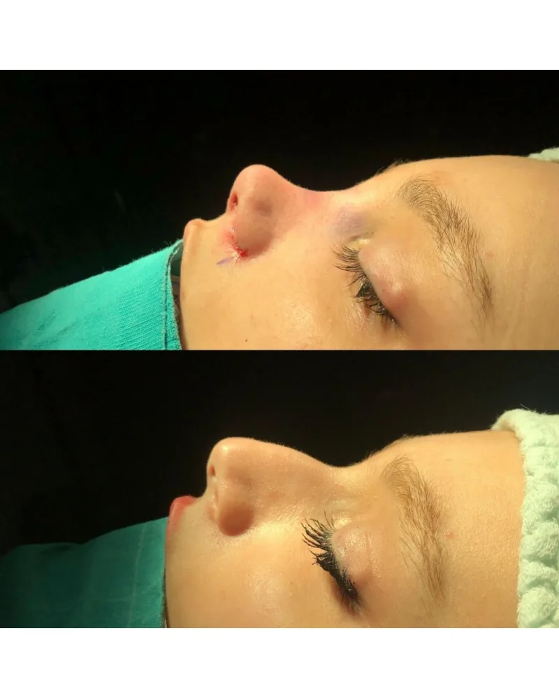 RİNOPLASTİ