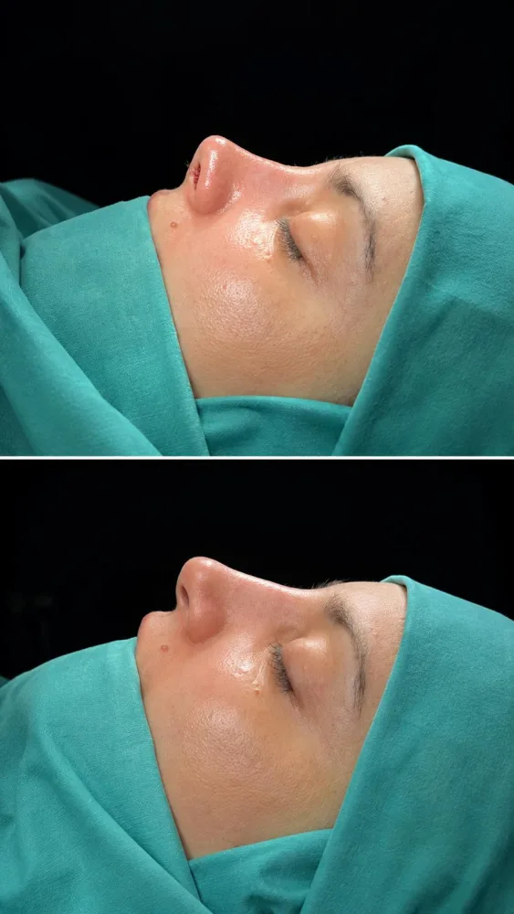 Septorhinoplasty