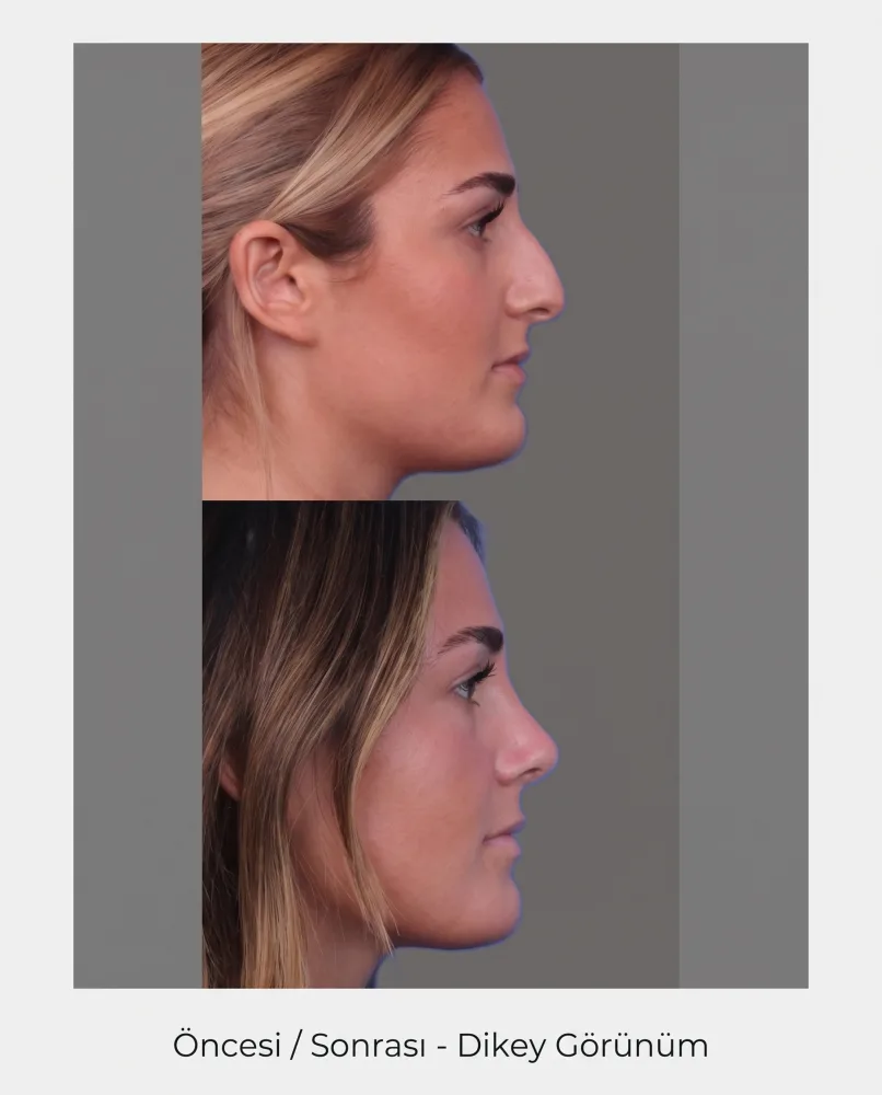 Rhinoplasty