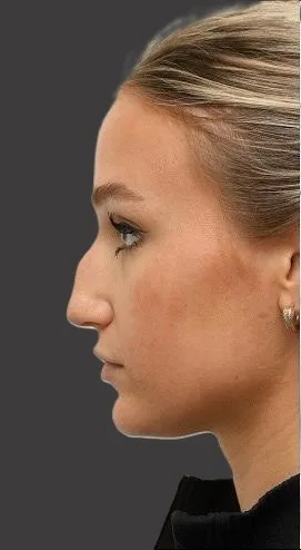 Rhinoplasty