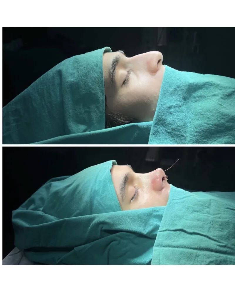 RİNOPLASTİ